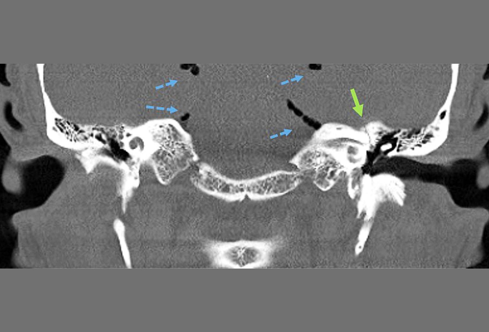 Felsenbein_CCTmit_Pfeil_-_Kopie