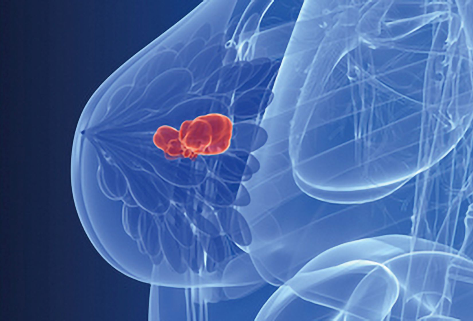 Fotolia_20706710_Brustzentrum_4