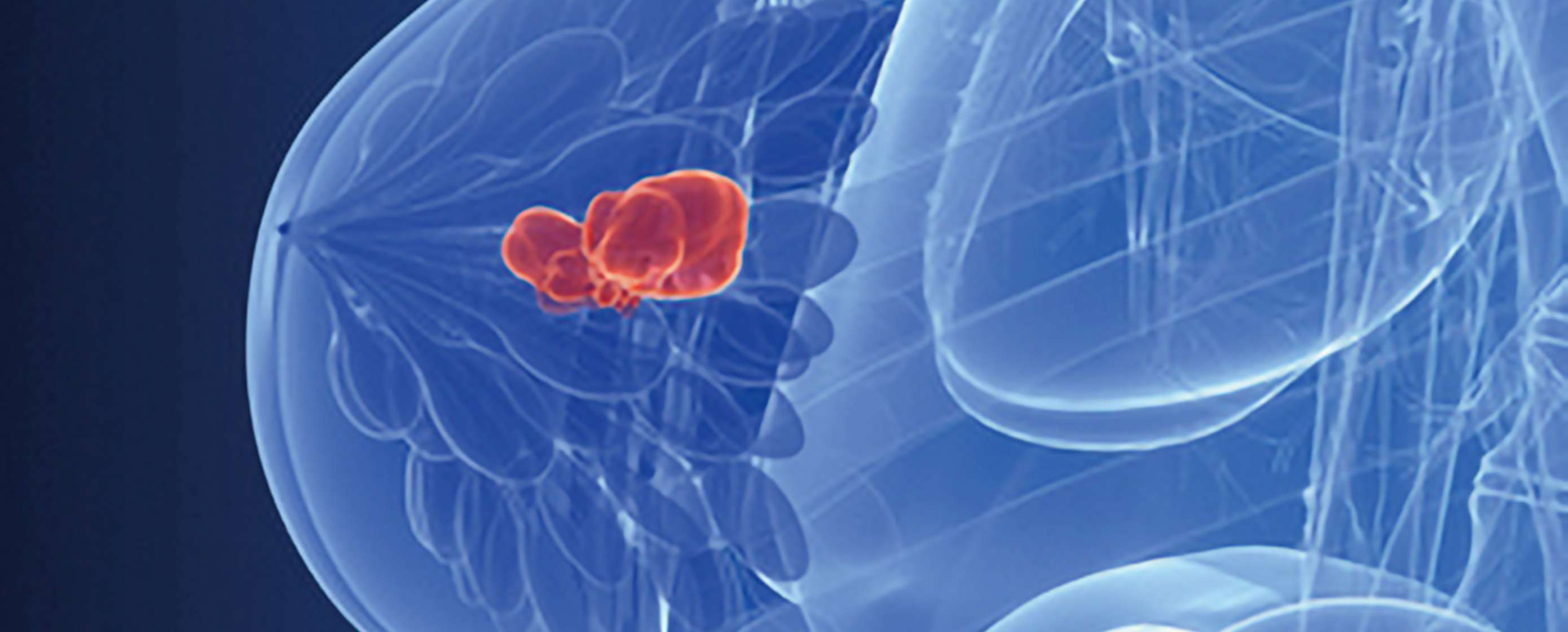 Fotolia_20706710_Brustzentrum_4