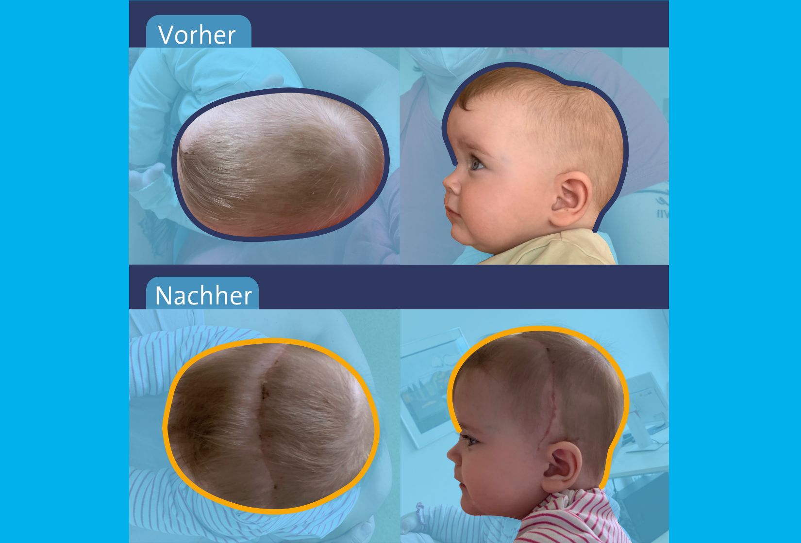 Grafik_SchaedelnahtOP_2