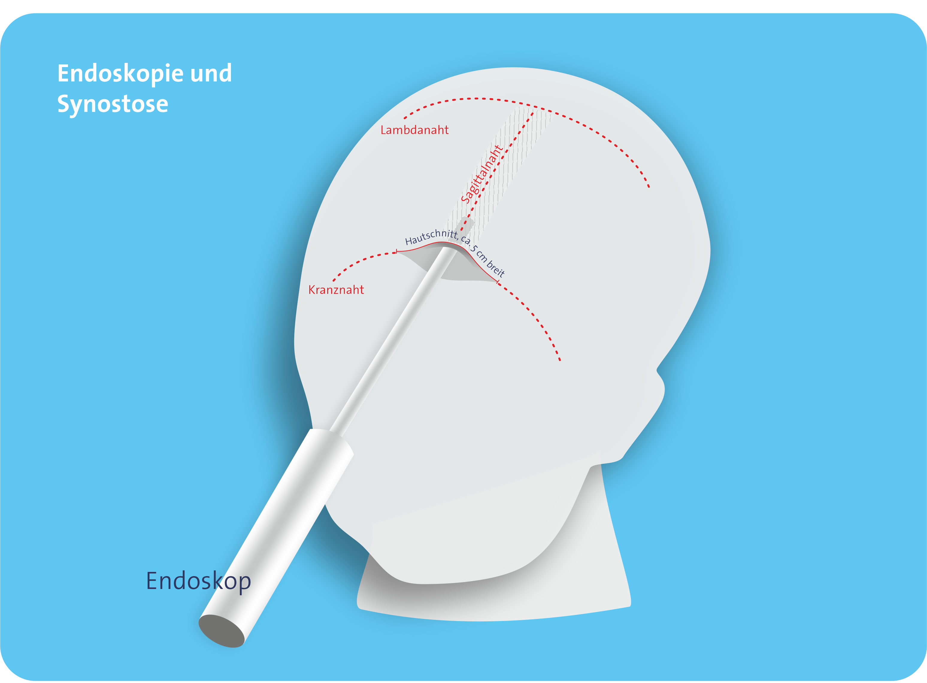 Schemazeichnung_Endoskopie-Synostose