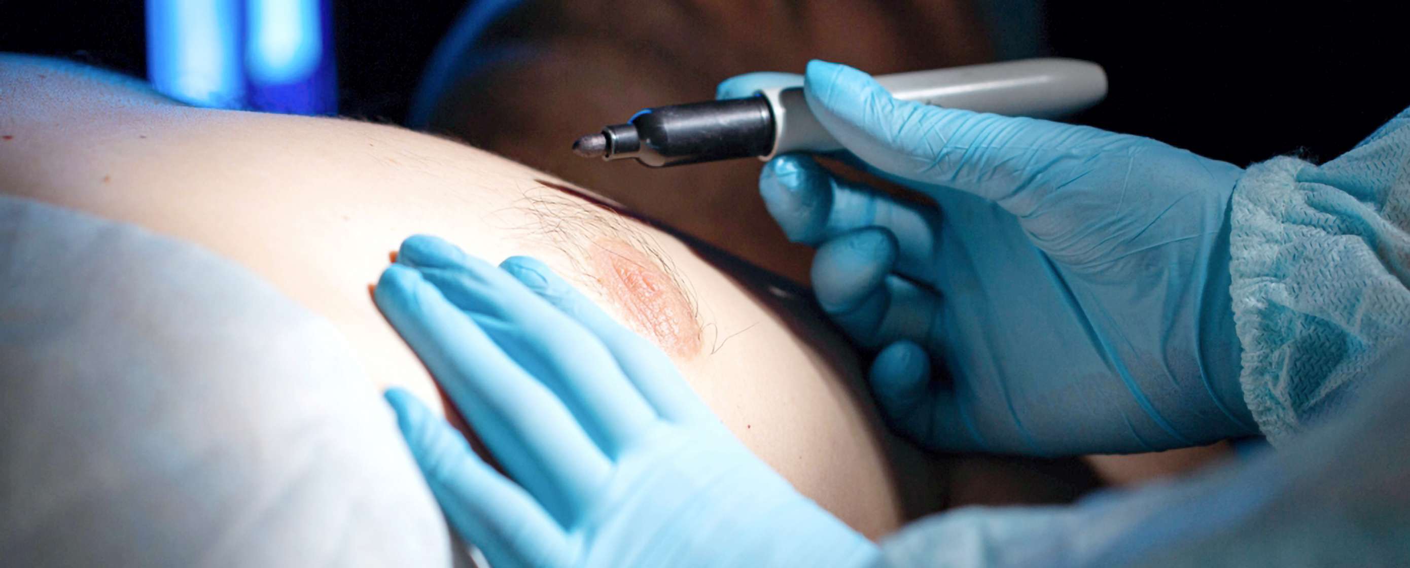 AdobeStock_Gynaekomastie_Header